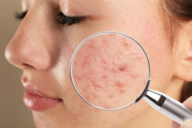 Skin Treatment