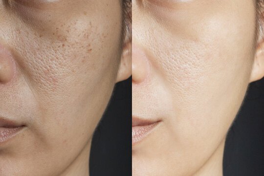 Treatment Result