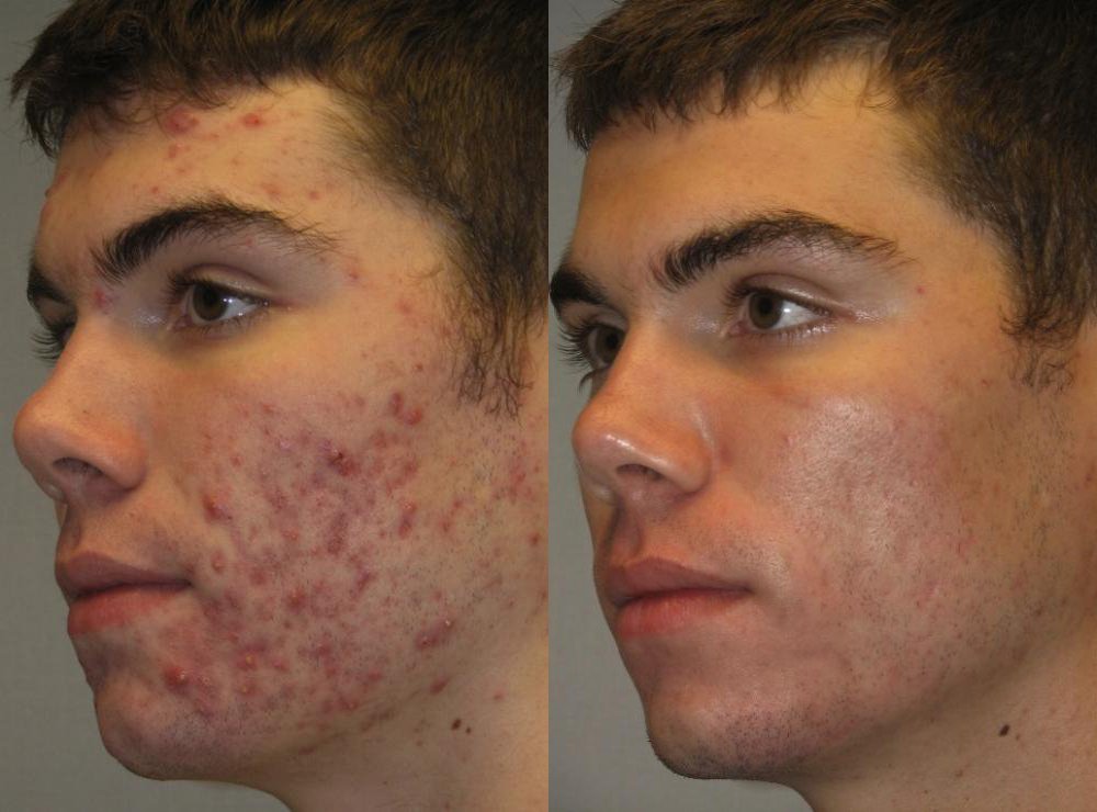 Treatment Result
