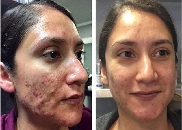 Treatment Result